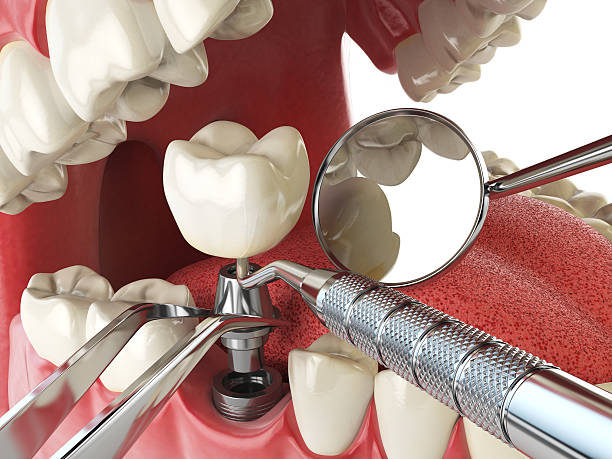 Best Root Canal Emergency Dentist  in Benld, IL